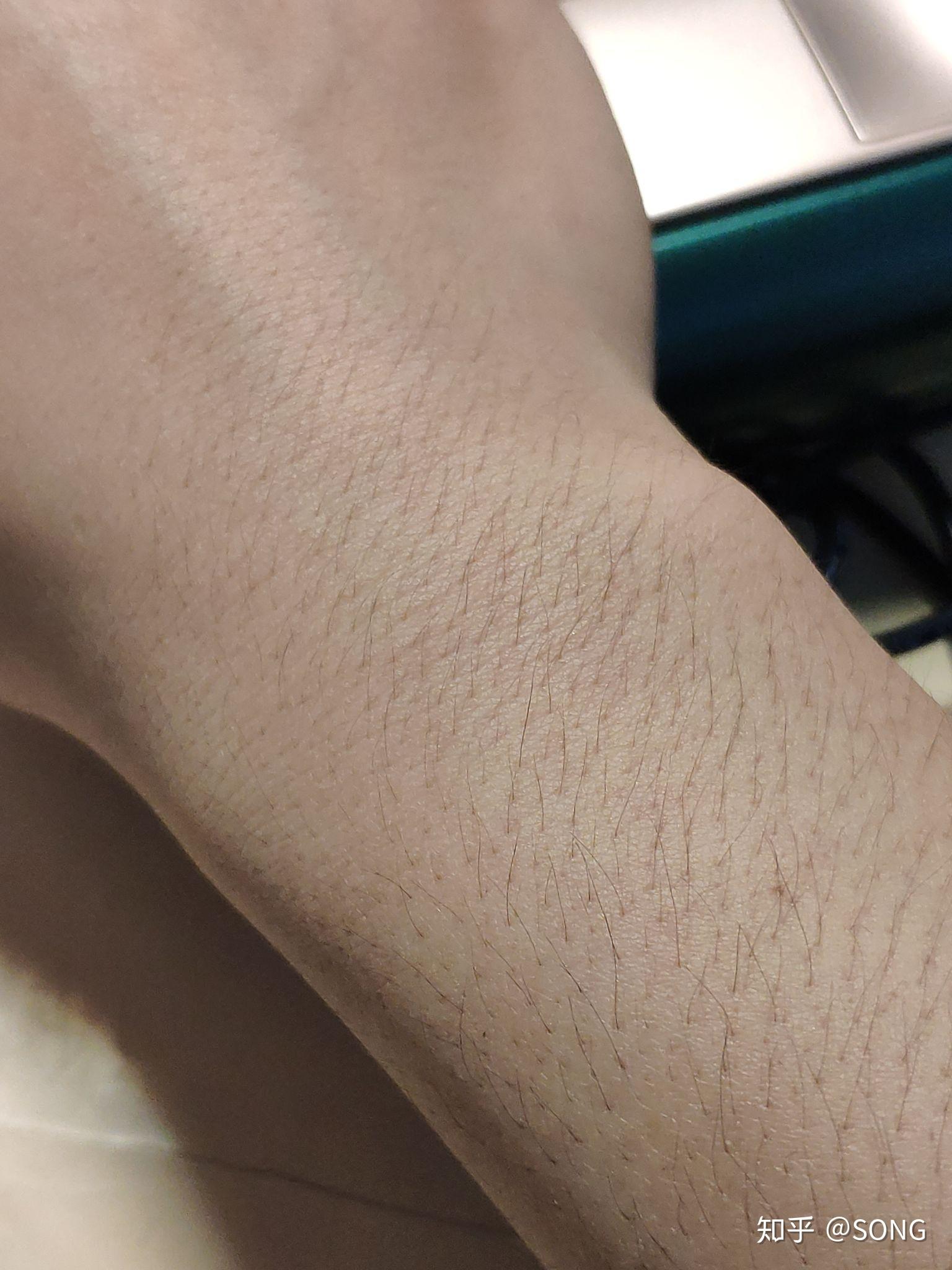 15岁女生汗毛很重父母不让脱毛怎么办