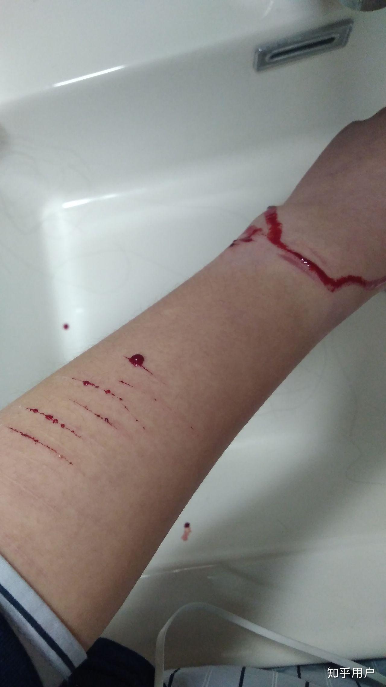 忧郁症自残是什么感觉?