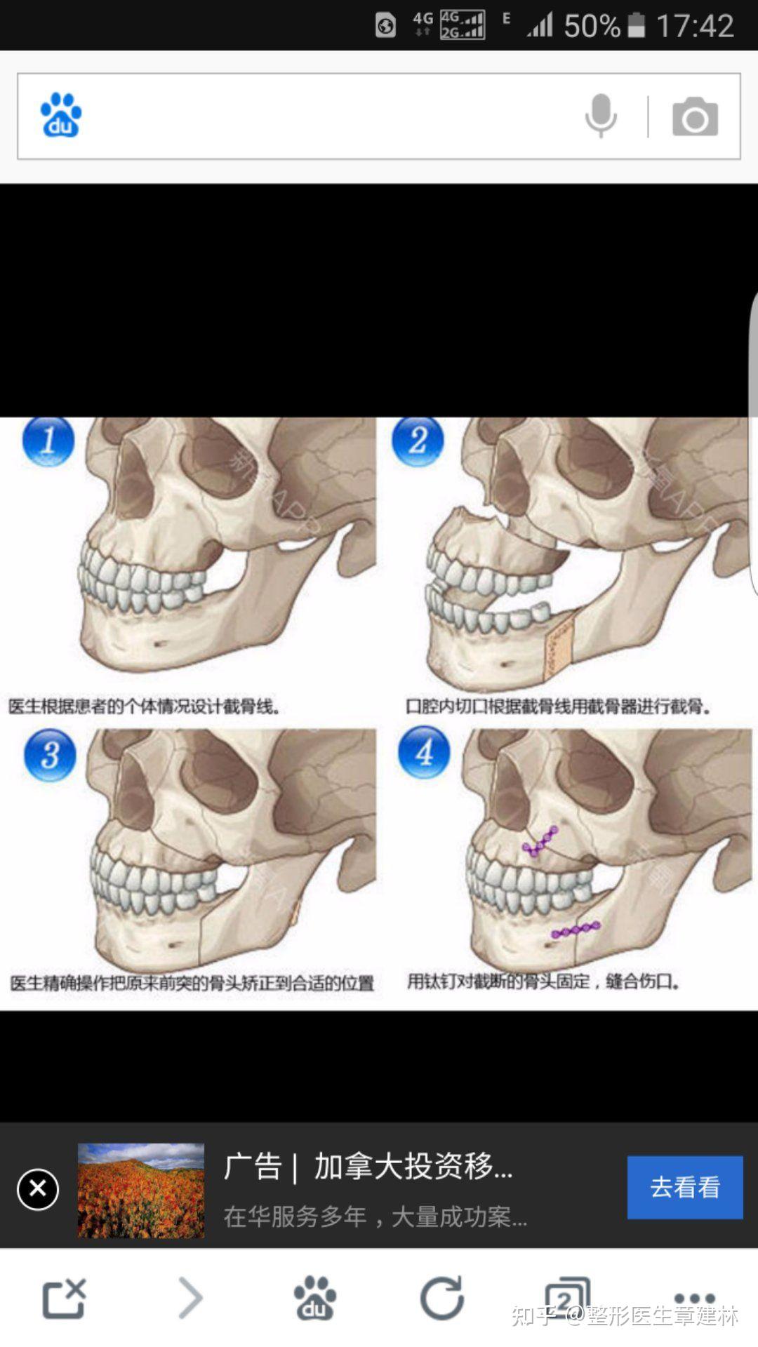 案例分享 | 矫正前内倾型深覆合，牙列拥挤有虎牙，咬合不当，颞下颌关节紊乱，下巴后缩，牙弓真的非常方 - 知乎