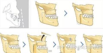 重庆正畸分享|如何解除个别牙反合(地包天)与牙列不齐? - 知乎