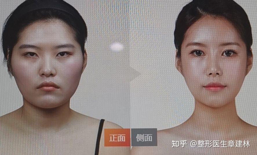 颧骨和颧弓有什么区别,颧弓外扩和颧骨高对脸型分别是什么样的影响? - 知乎