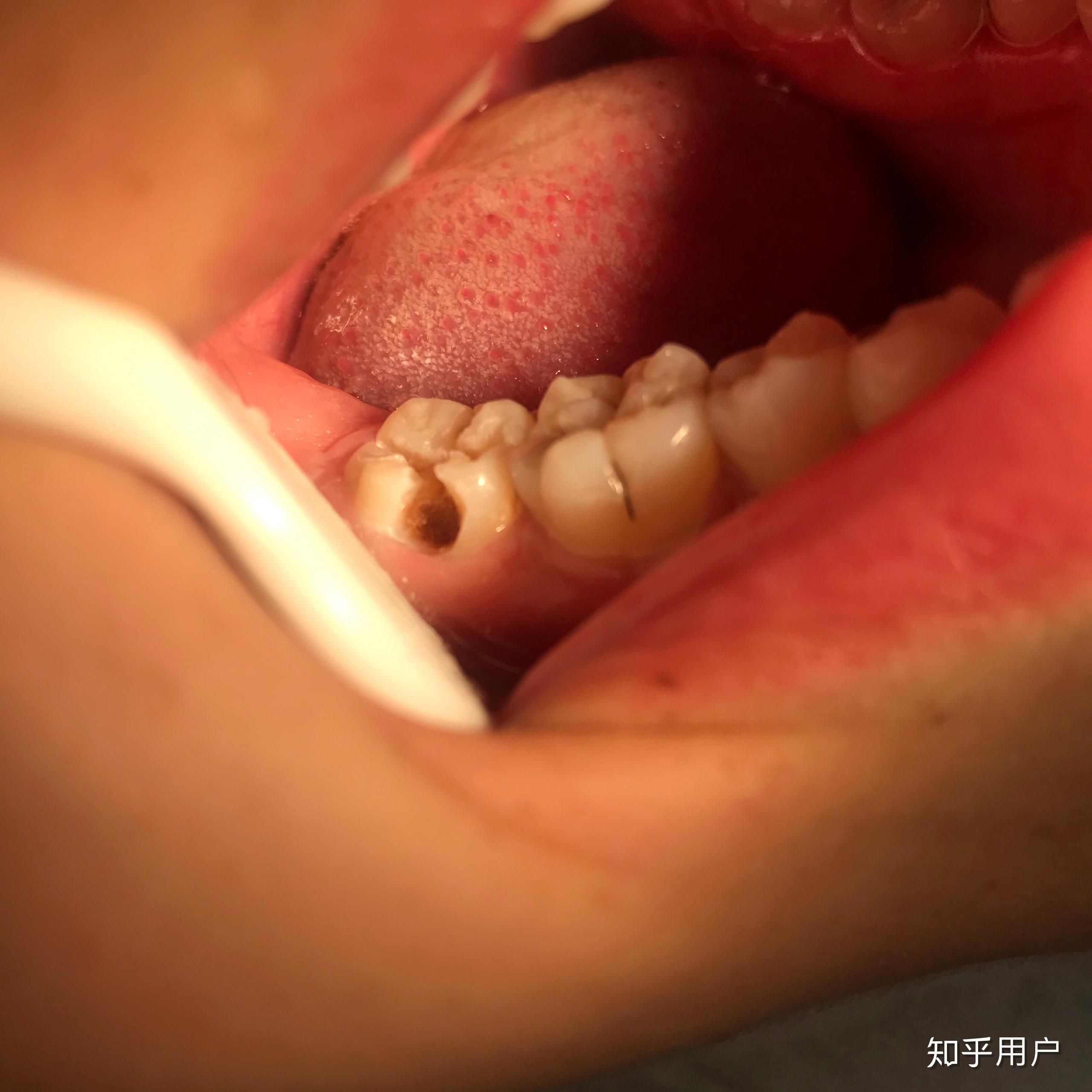 满口蛀牙补了很多牙是种怎样的体验? - 知乎