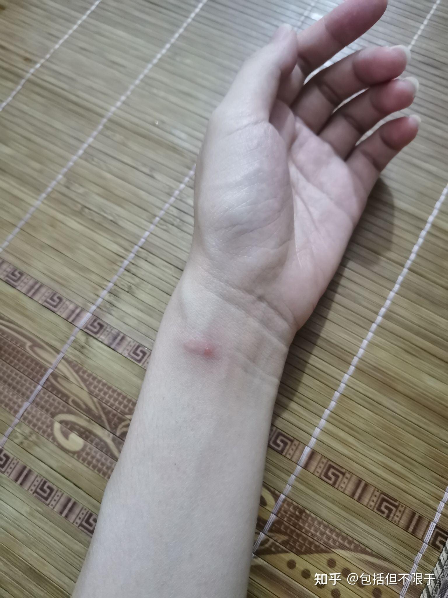 被红蚂蚁咬伤有什么症状? - 知乎