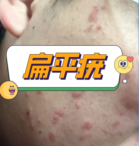 说说扁平疣怎么治疗? - 知乎