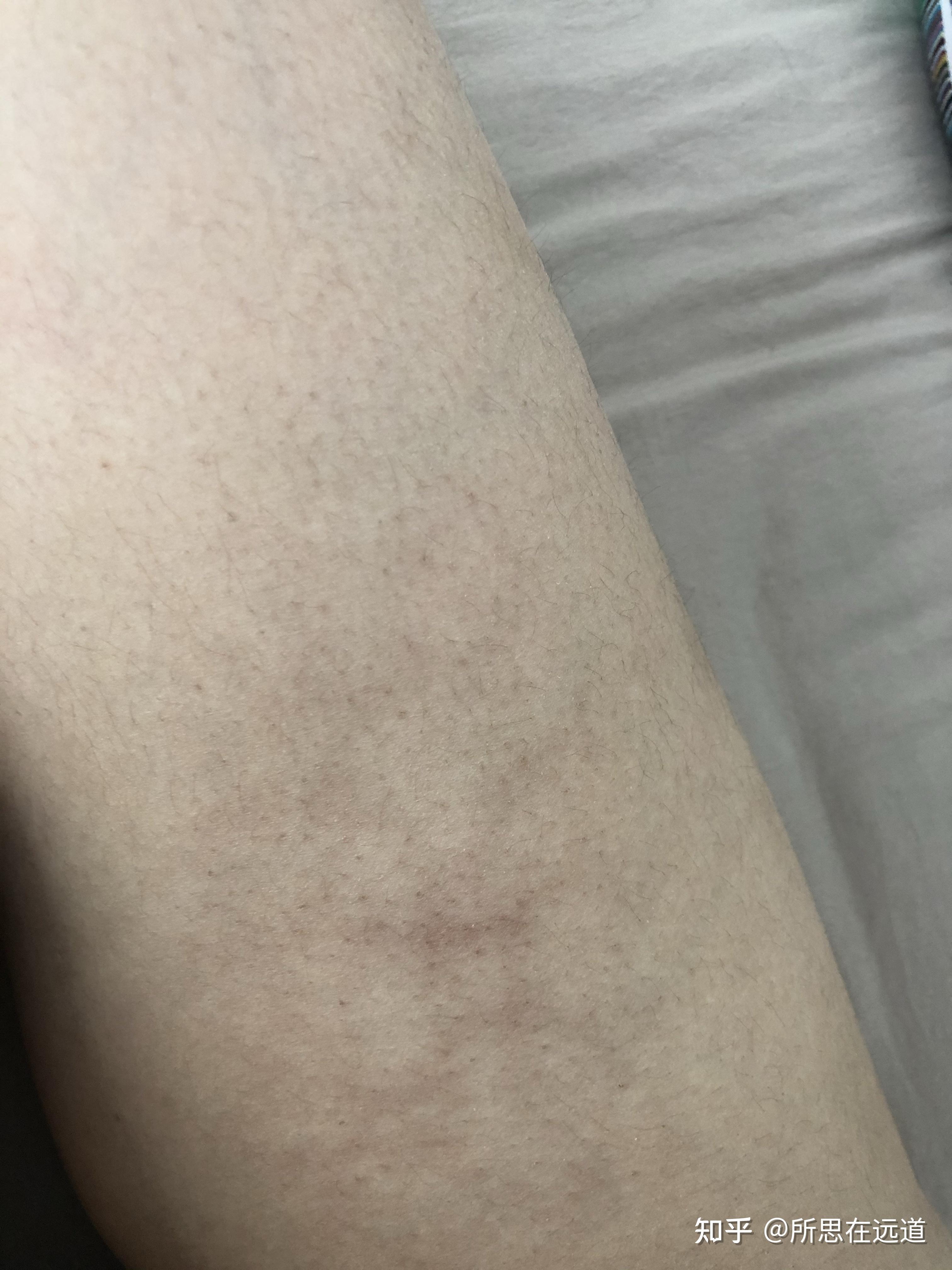 大腿内侧有红色网状条纹是怎么回事? - 知乎