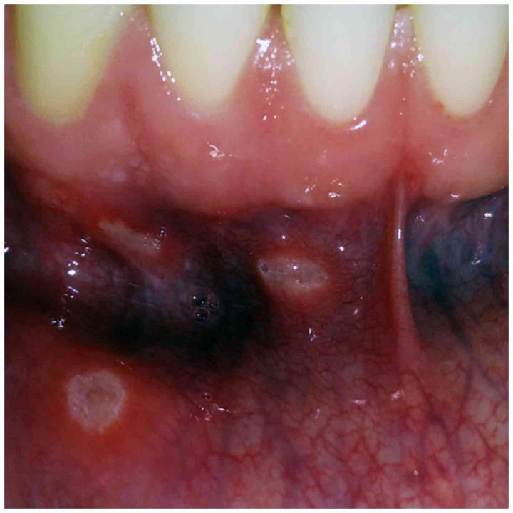 口腔溃疡Oral ulceration - 知乎