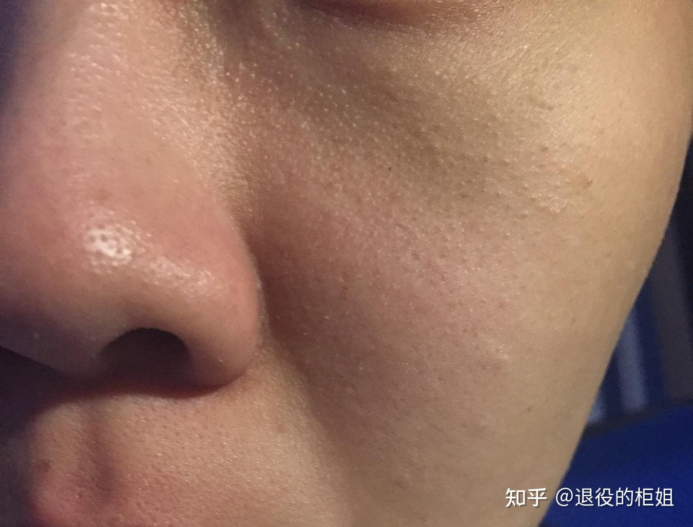 请问脸上的粉刺白头闭口脂肪粒改怎么去?