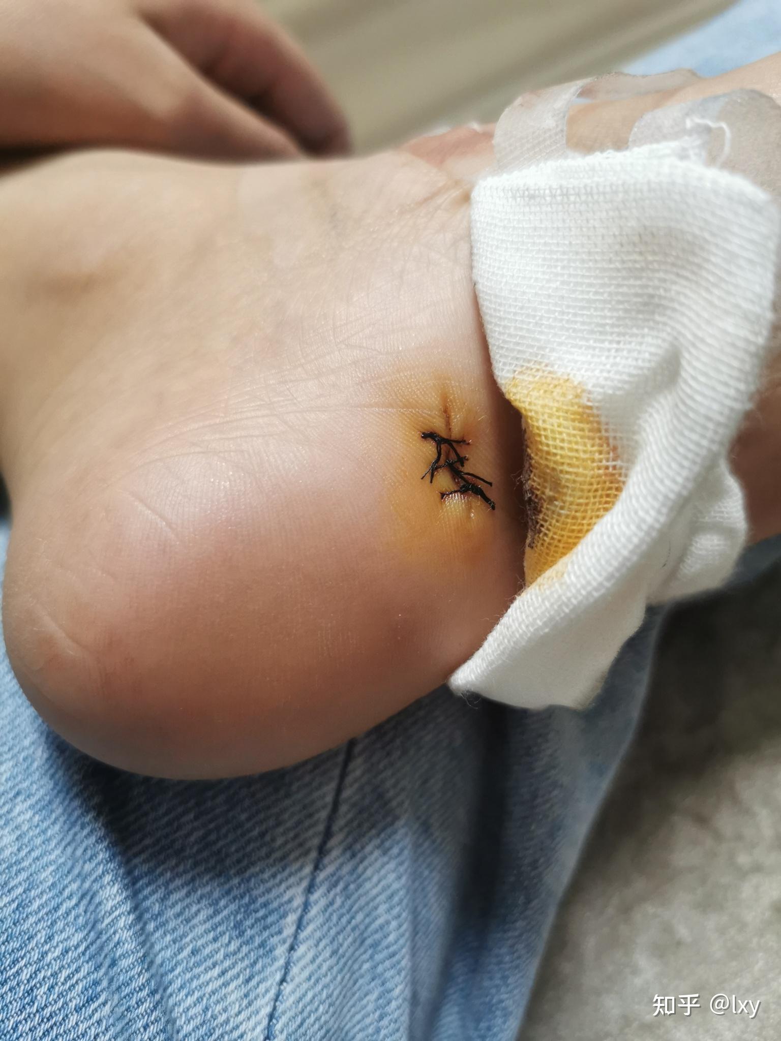 手术切脚底痣是怎么样的体验? - 知乎