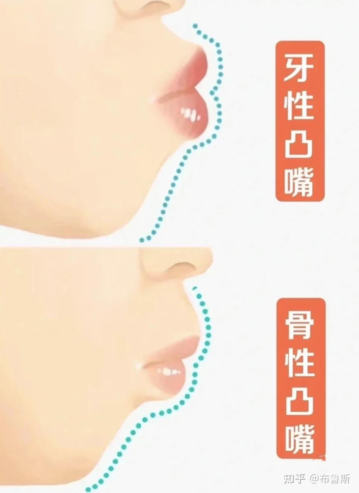 如何判断自己嘴凸还是下巴后缩? - _小百科