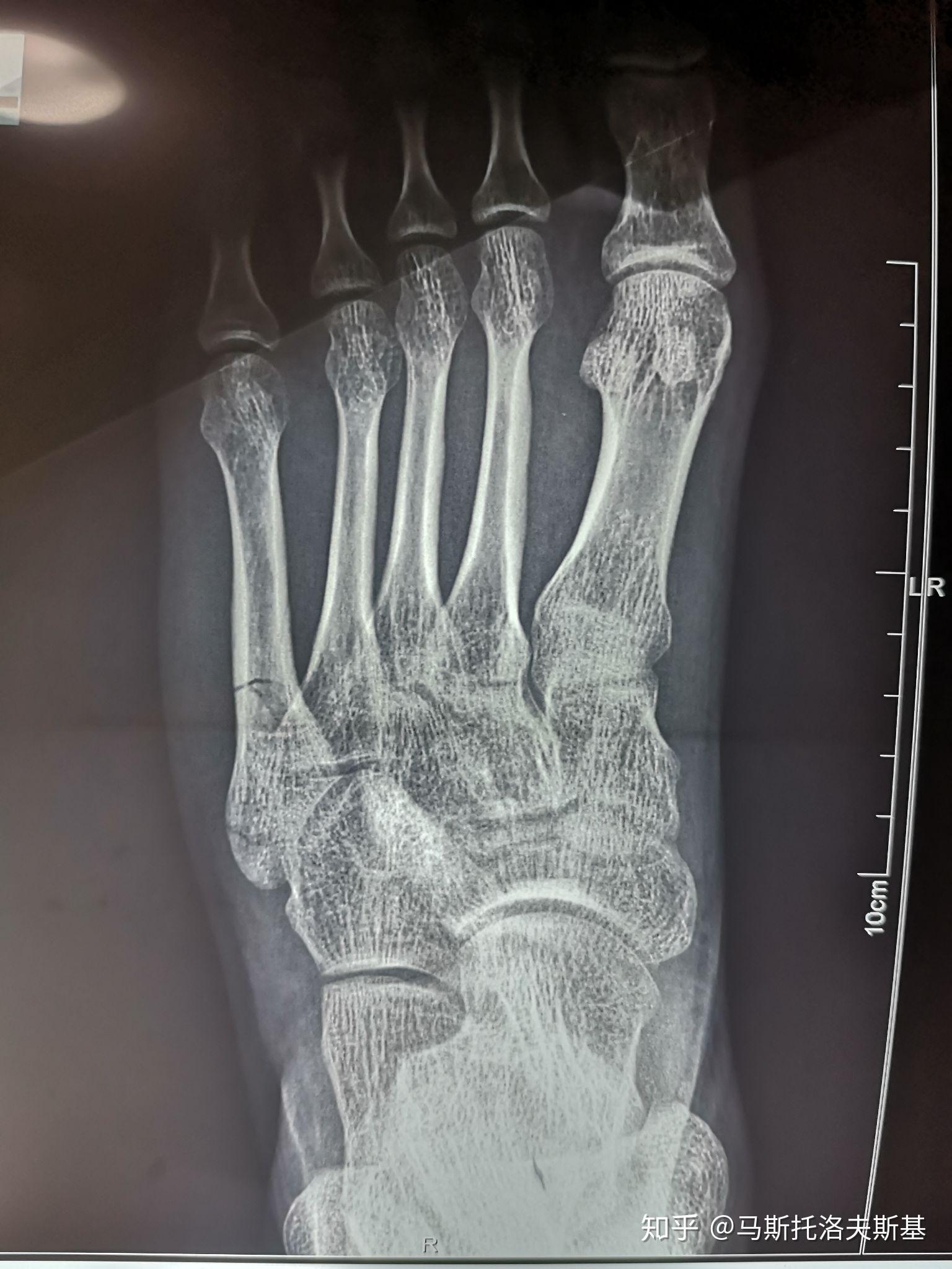 左脚第五跖骨骨裂图片图片