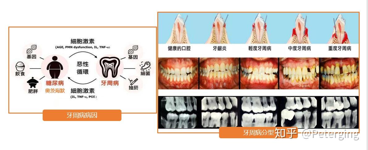 中年人三十至四十岁牙齿容易松动脱落的原因是什么啊