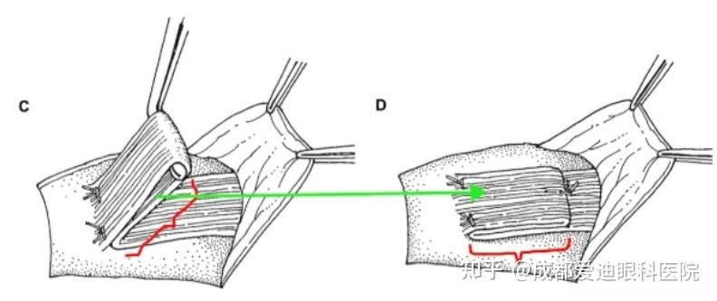 眼球斜視手術NGO水針刀 3D 美兆診所金門