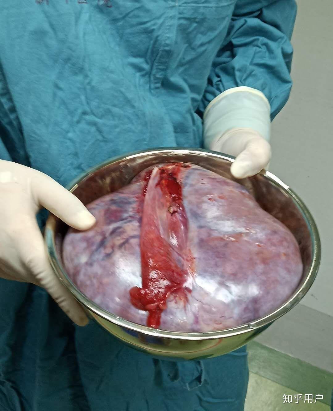 无性细胞瘤中晚期,抗癌日记.怎样熬过化疗的反应? - 知乎