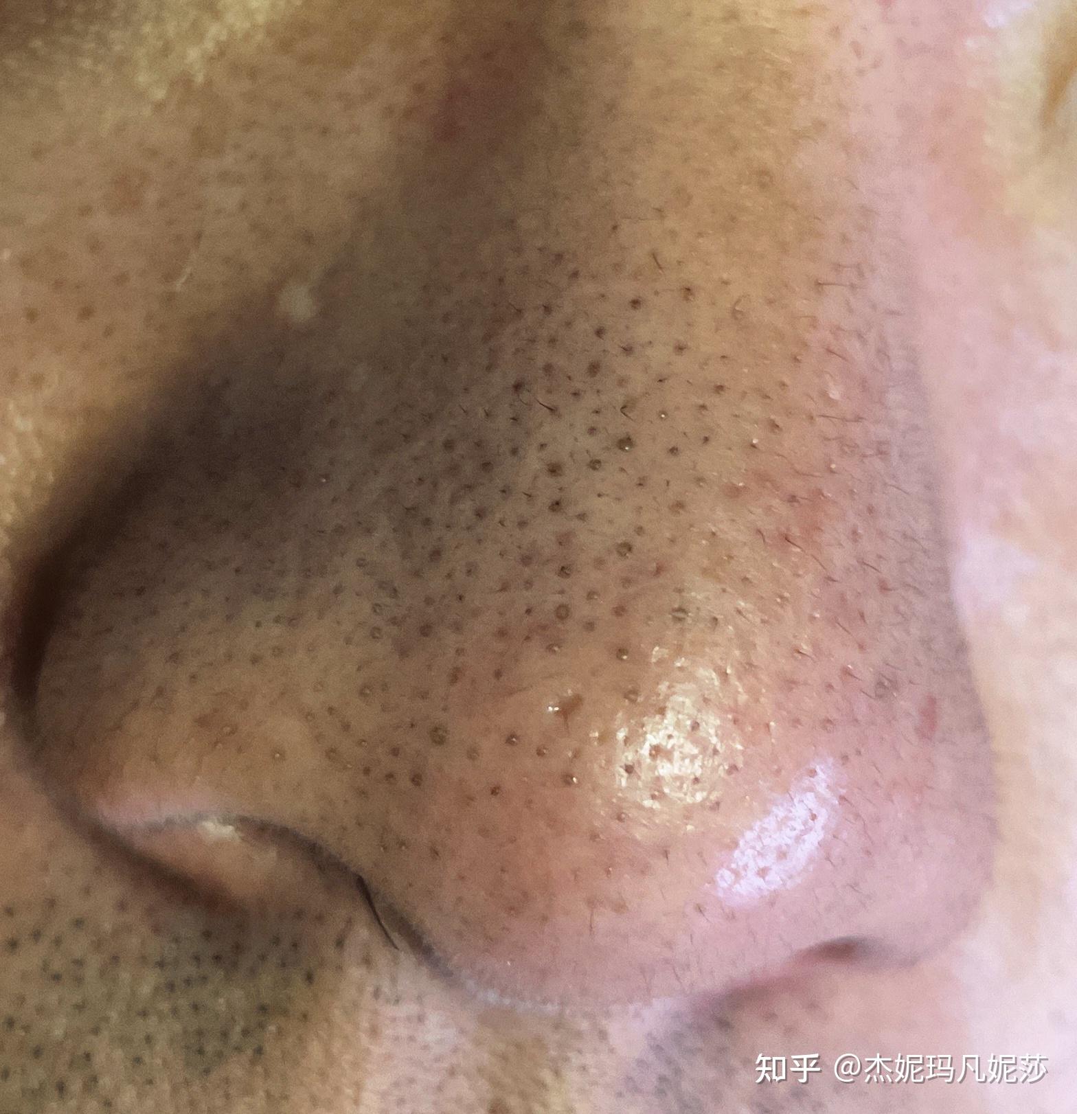 男生皮肤白皙但是夏天爱出油,而且鼻子上好多黑头,毛孔也有点粗大,怎