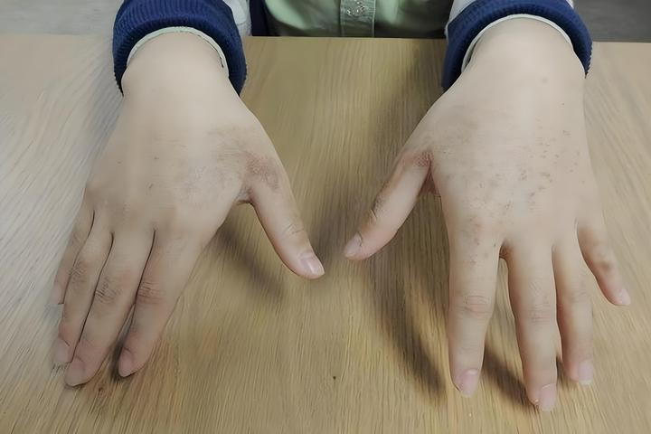 会读荨麻疹，居然不会读“荨麻”？这些植物名你能读对几个