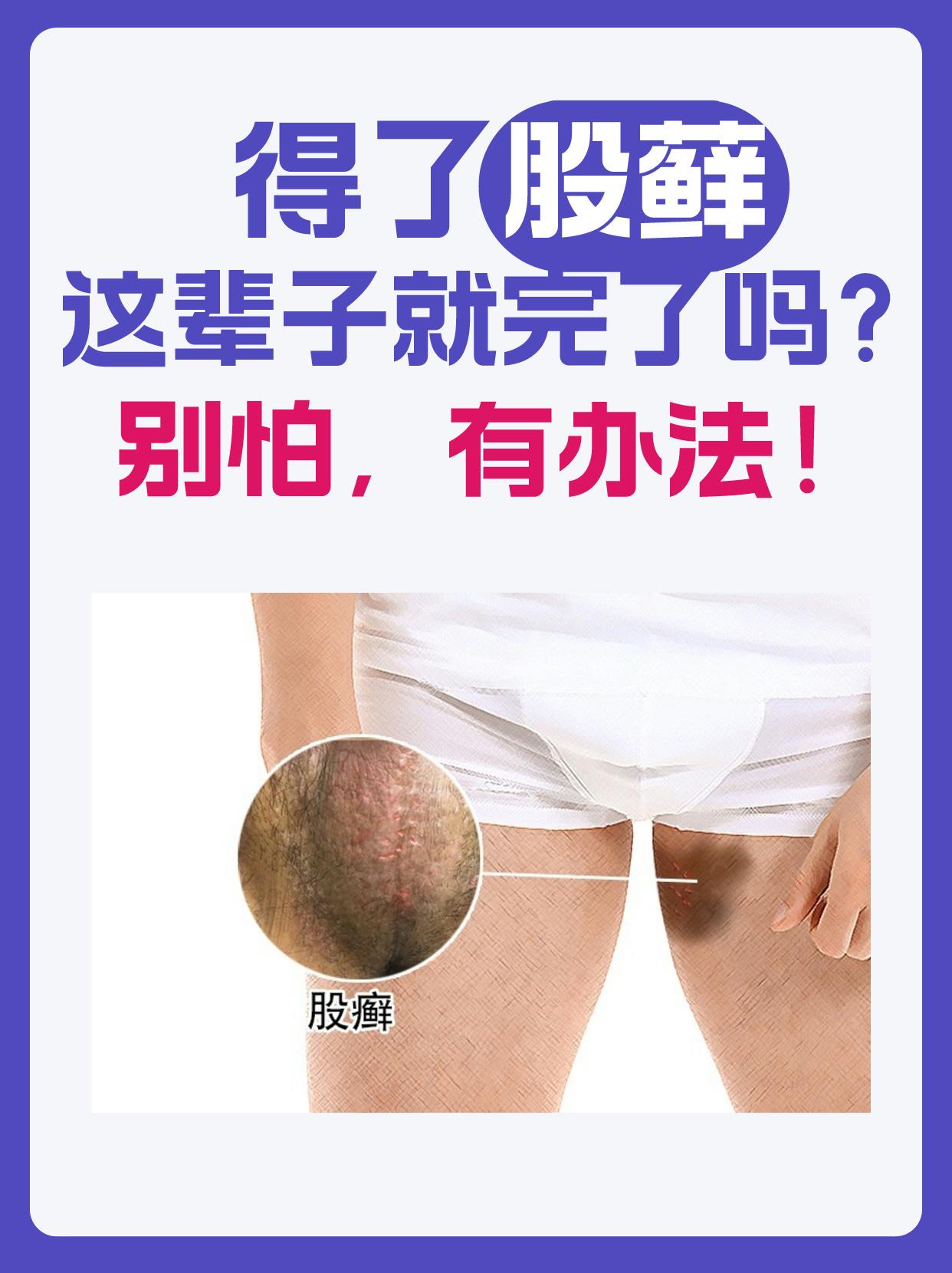 男性大腿肚内侧股癣图片