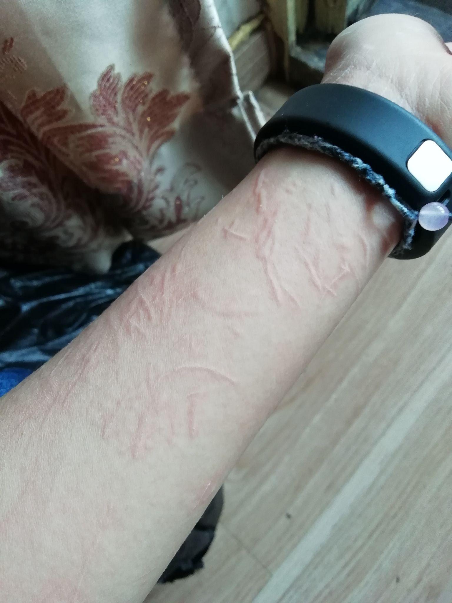 人工荨麻疹(皮肤划痕症)的原理是什么?有治疗的必要么?