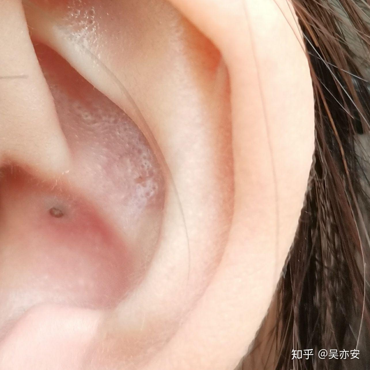 请问你们耳朵壁会长黑头吗?一颗一颗的黑的? - 知乎