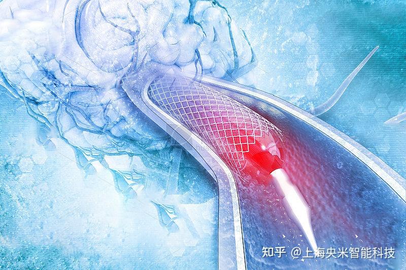 血管支架表面涂层制备 - 知乎