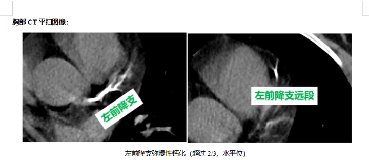 常规CT平扫报告如果描述有冠脉硬化、钙化字眼,需及时干预 - 知乎