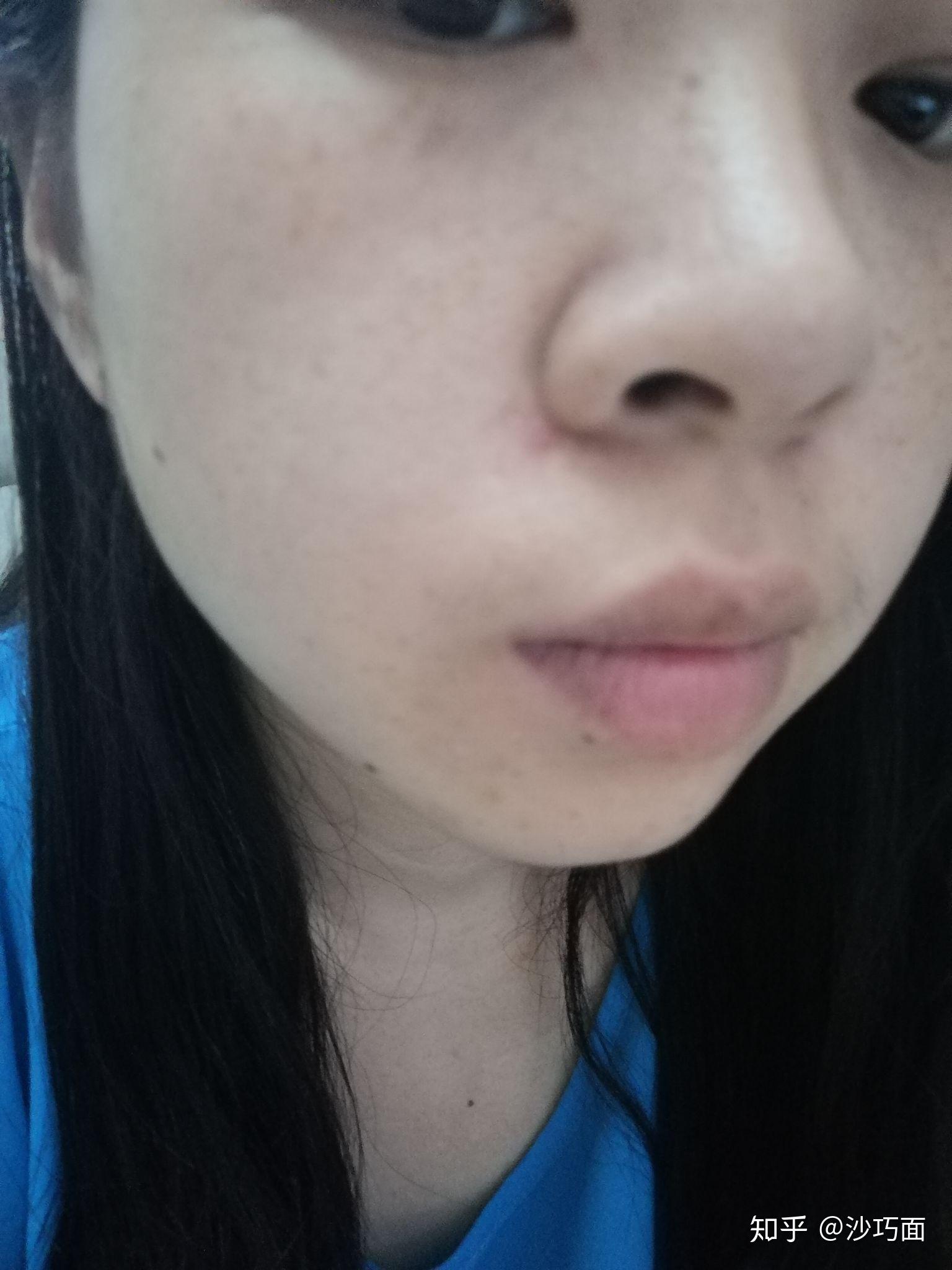 从小长在手上的痣,之前据说是平的,现在隆起一半褐色一半白色(已经