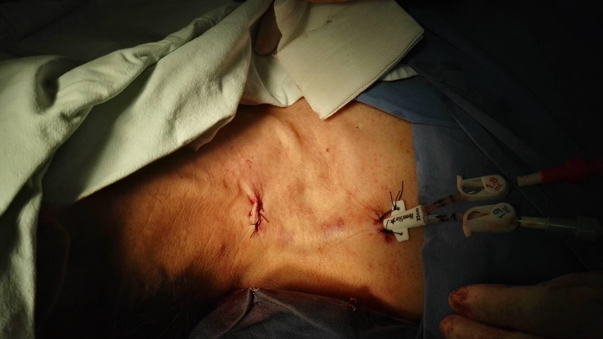 柳暗花明:经颈外静脉带cuff透析导管置入