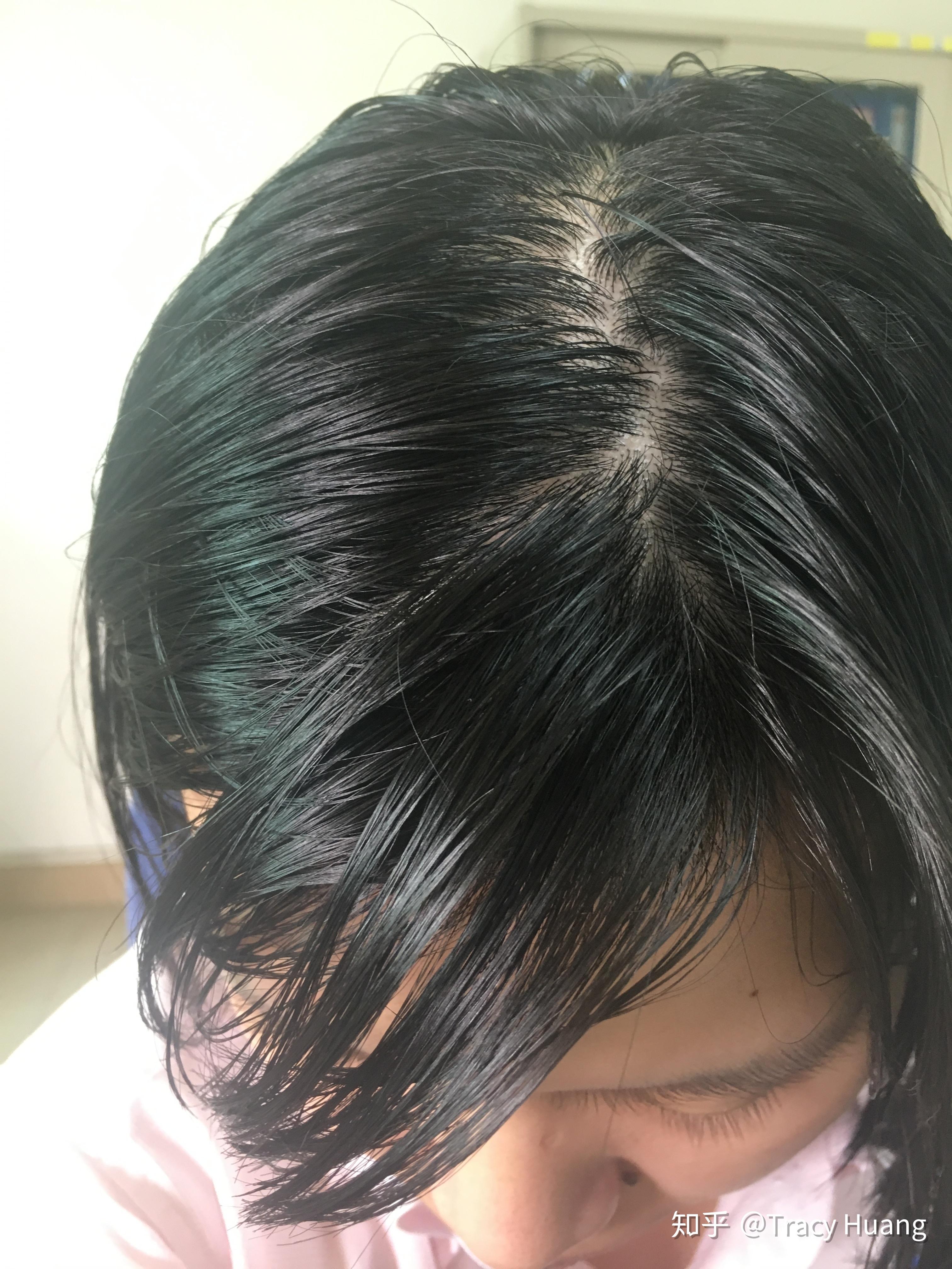 头发爱出油,有什么好的解决办法吗?