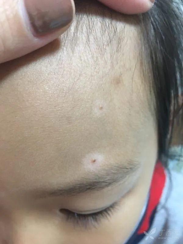 晕痣白癜风不一般教你认识它
