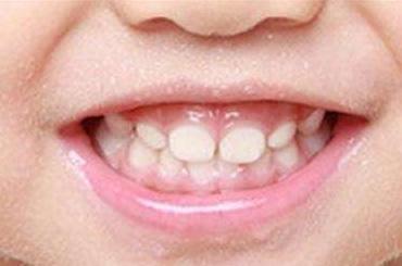 小孩子龅牙矫正需要多少钱
