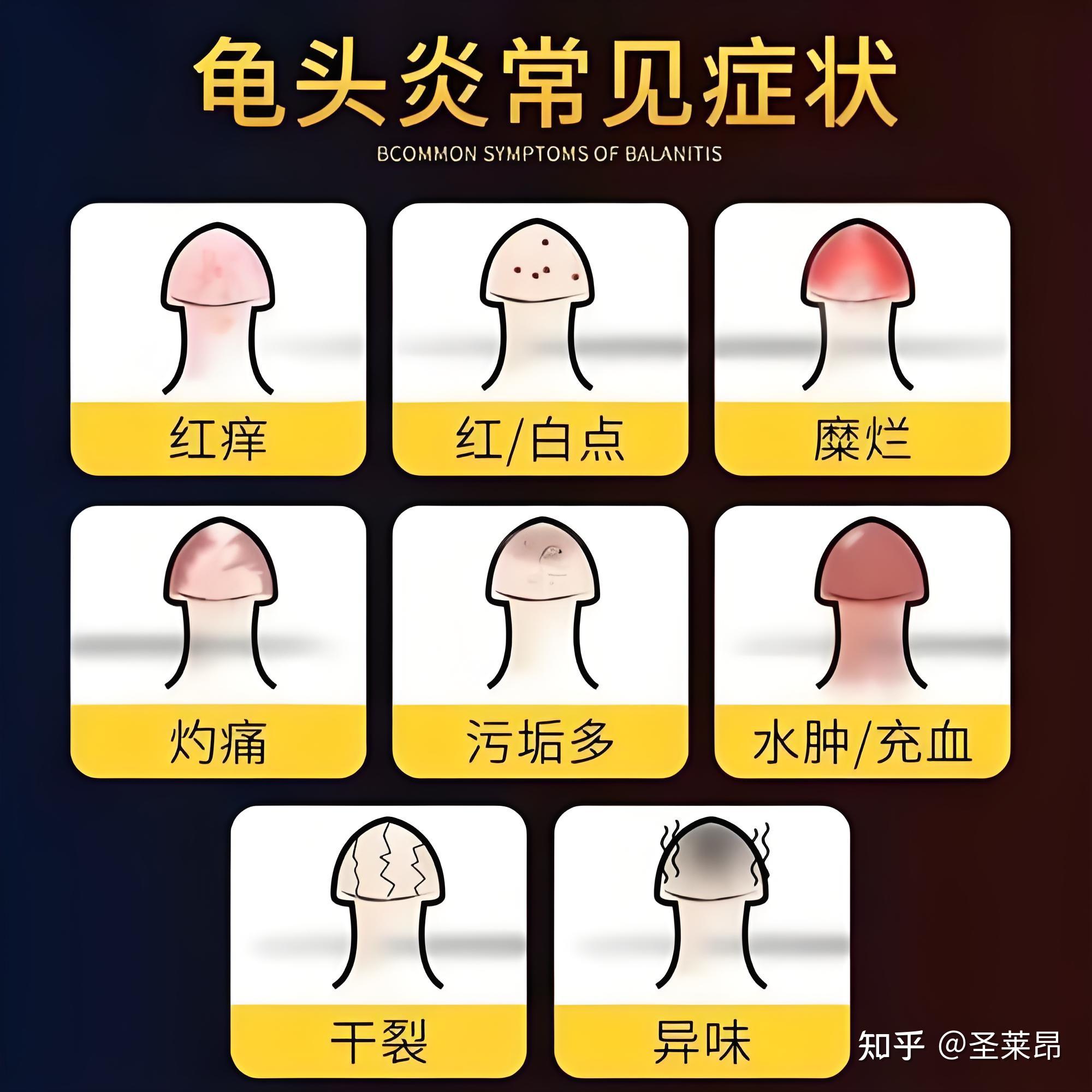 请问小儿包皮龟头炎怎么办?