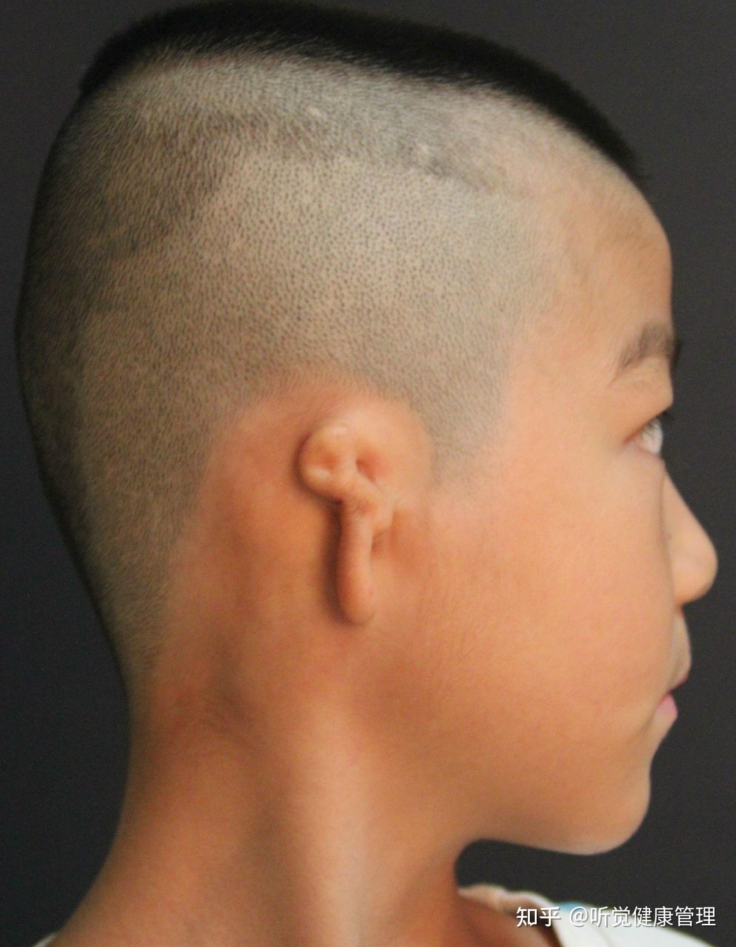 小耳畸形科普:孩子先天性耳朵畸形怎么办?