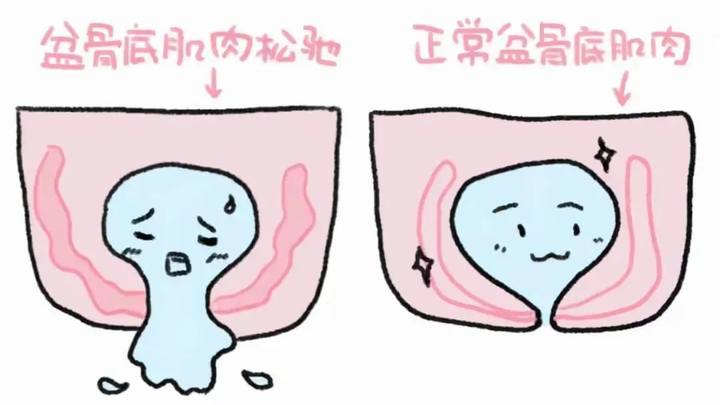 漏尿还要分程度？平时咳嗽/跑步/大笑等要漏尿的姐妹要注意啦，赶紧看看你是哪种程度 - 知乎