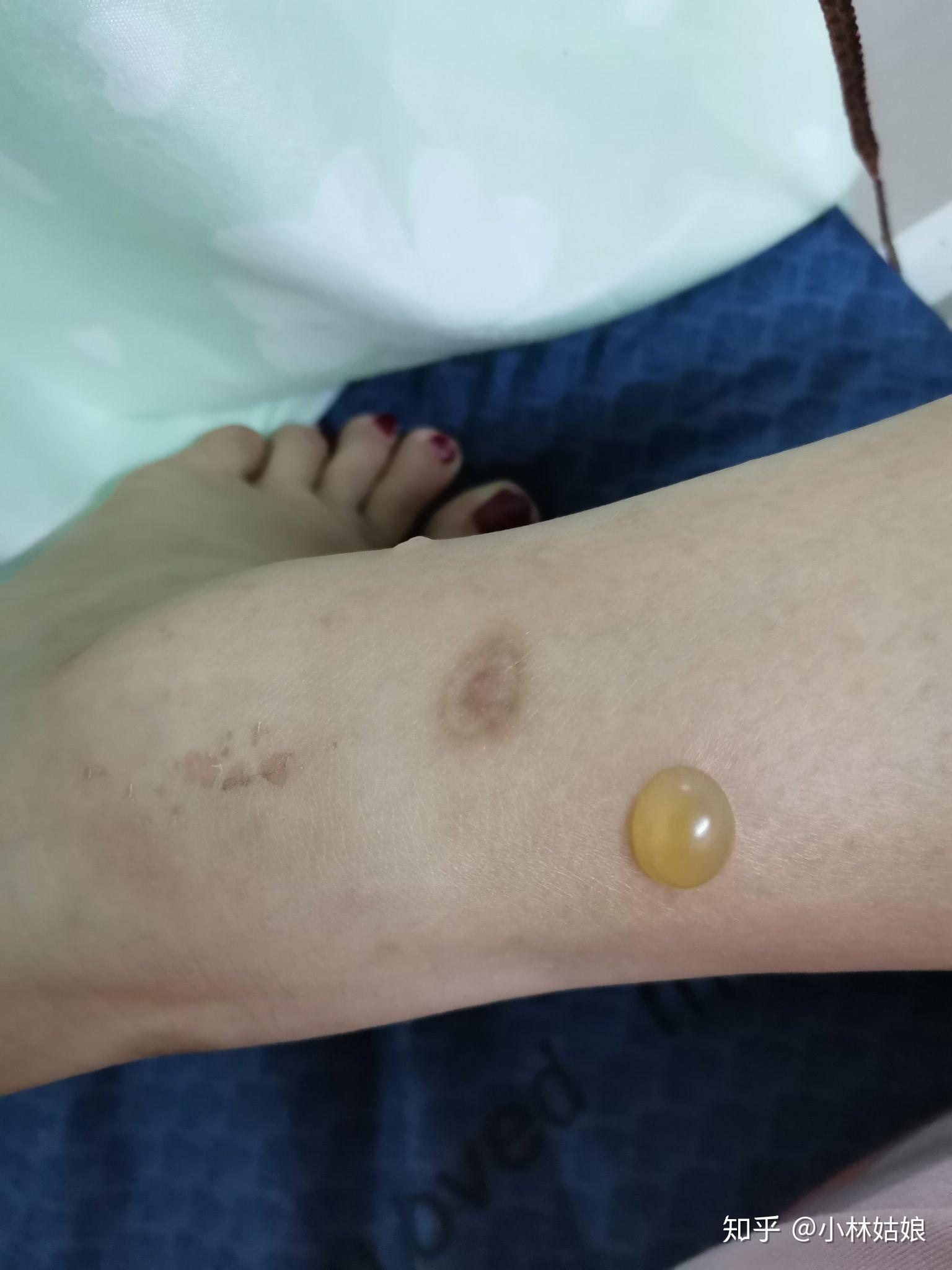 被它咬了有点红肿,还起了几个小水泡 ,应该怎么除掉这种虫? - 知乎