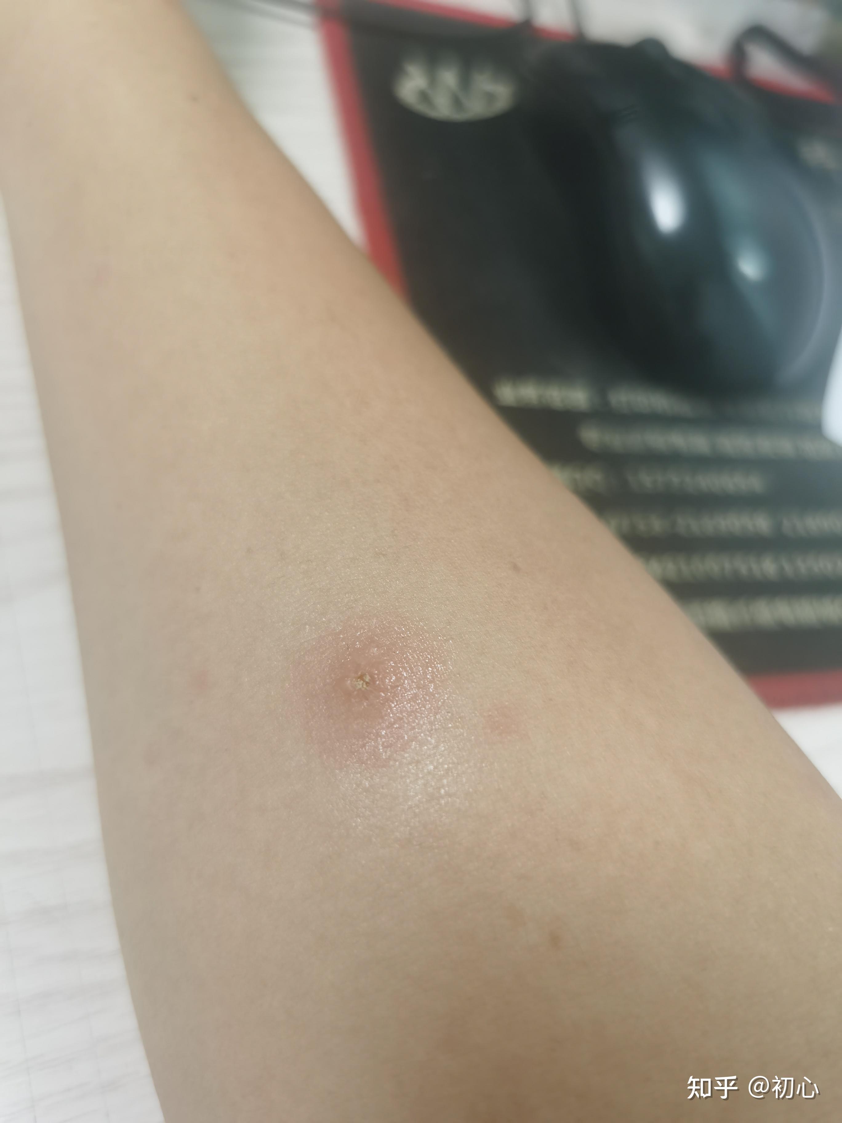 成人长水痘是什么样的经历