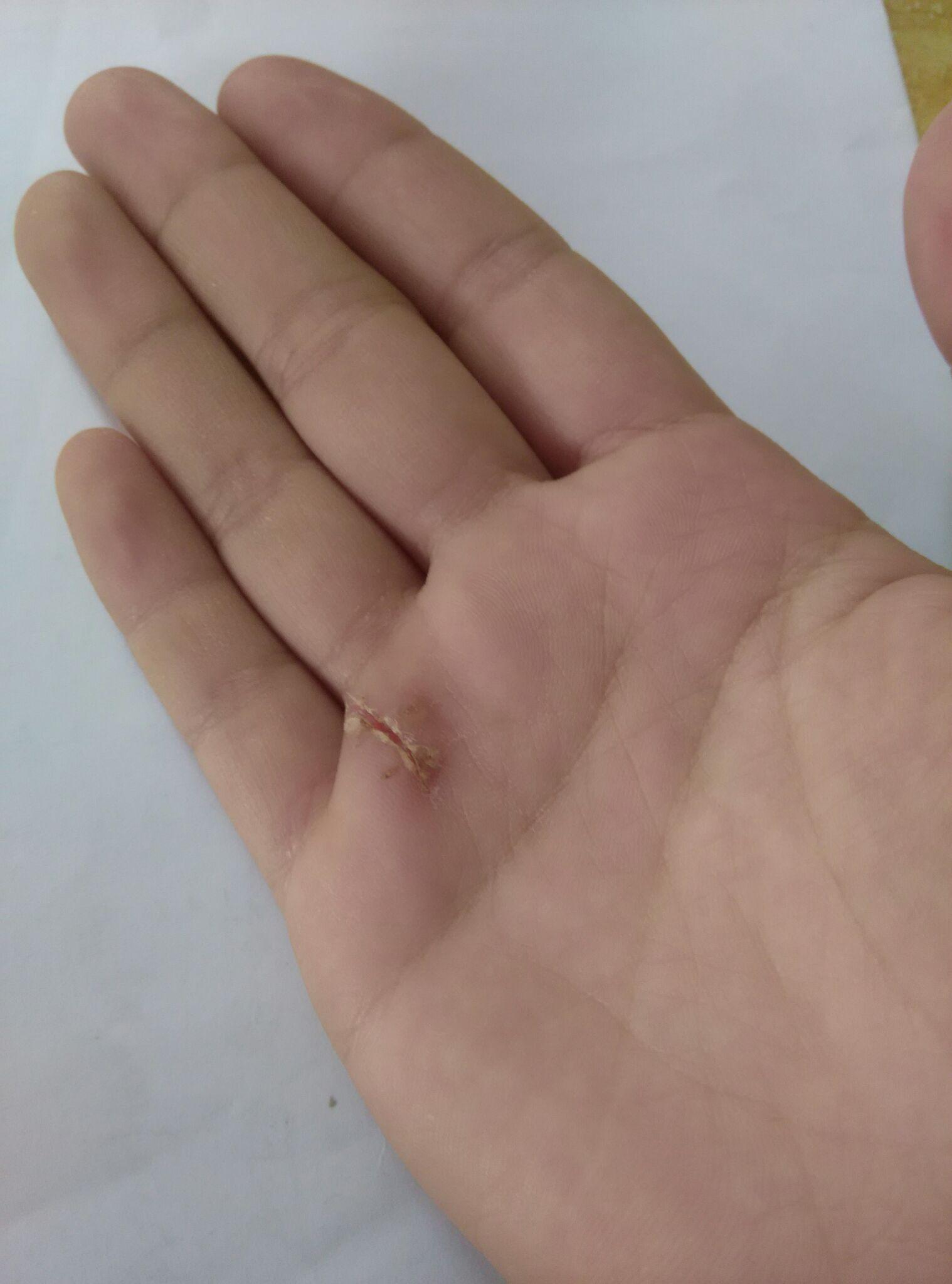 手掌割伤了,缝了5针,还没拆线,好几天没洗澡了,现在想洗澡,请问该怎么