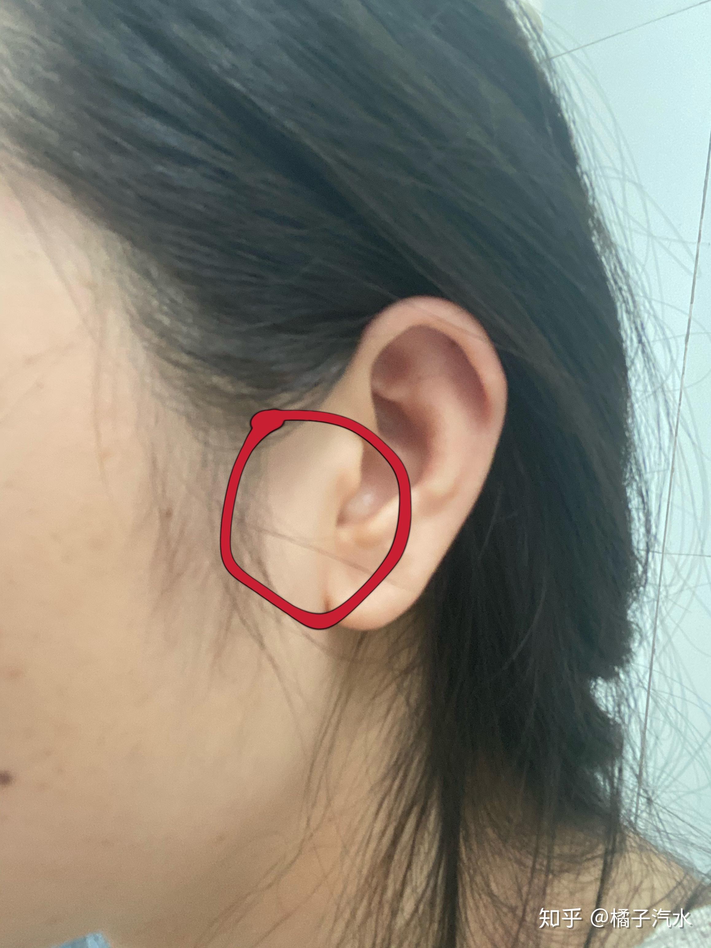 耳朵靠近脸颊那边有个硬块.