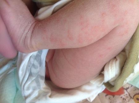宝宝腿上干性湿疹图片