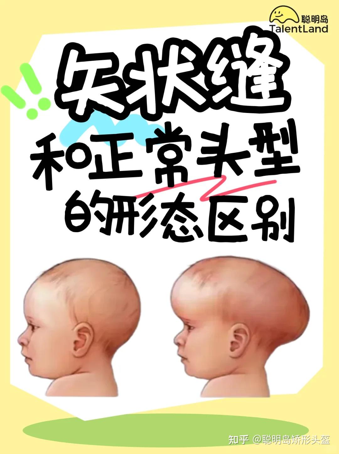 宝宝舟状头？家长们别慌！一文搞懂矢状缝早闭 - 知乎