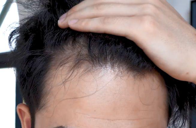 持续熬夜会导致严重脱发吗