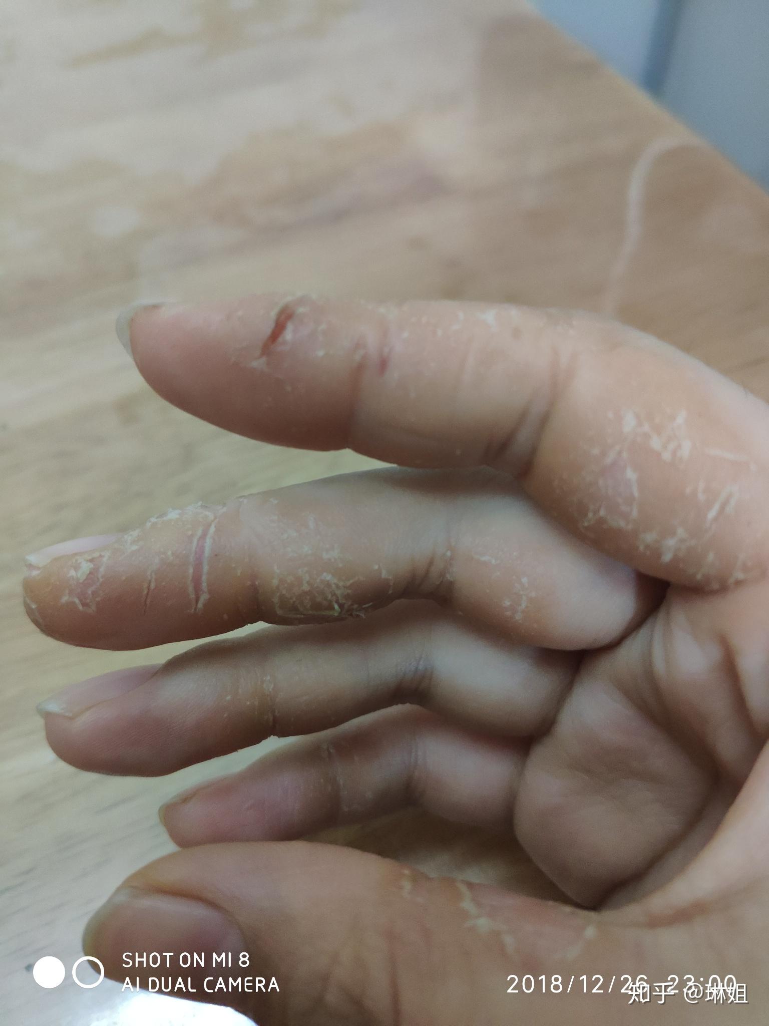 手上干裂型湿疹在哪里看比较好?