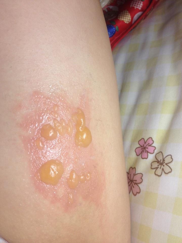 手被开水烫伤了怎么办? - 知乎