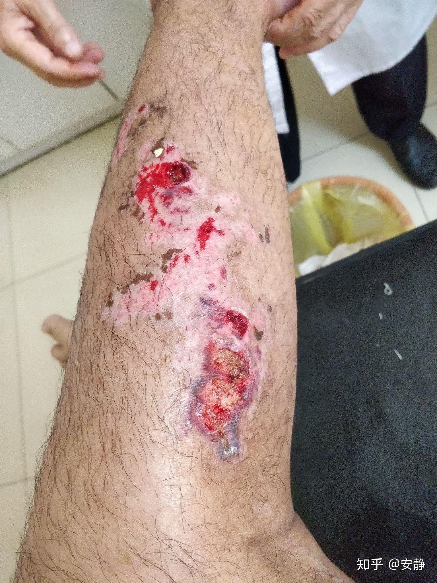 伤口化脓怎么办会不会好不了