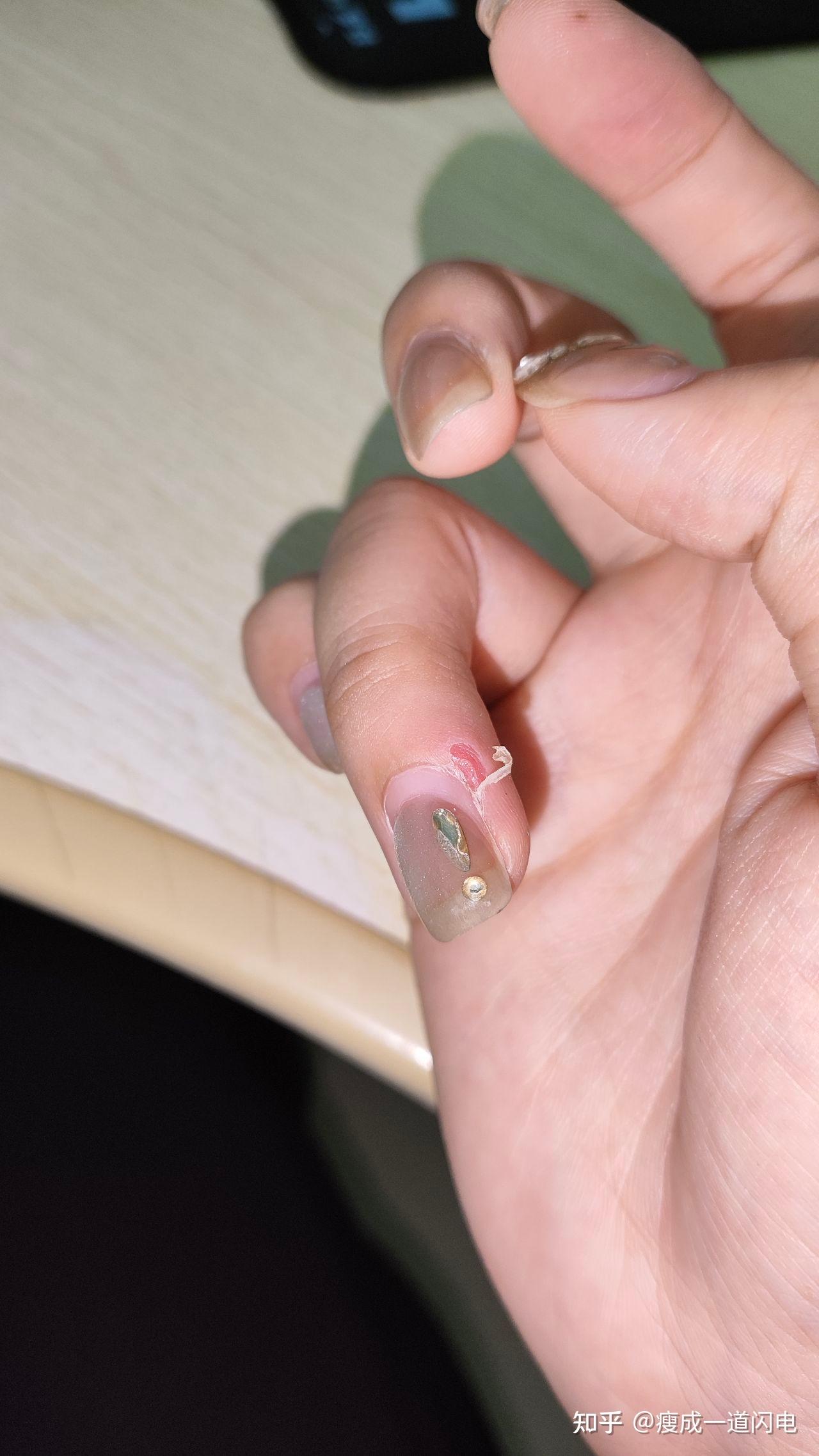 手指上长的倒刺如果一直倒着拔会是什么结果