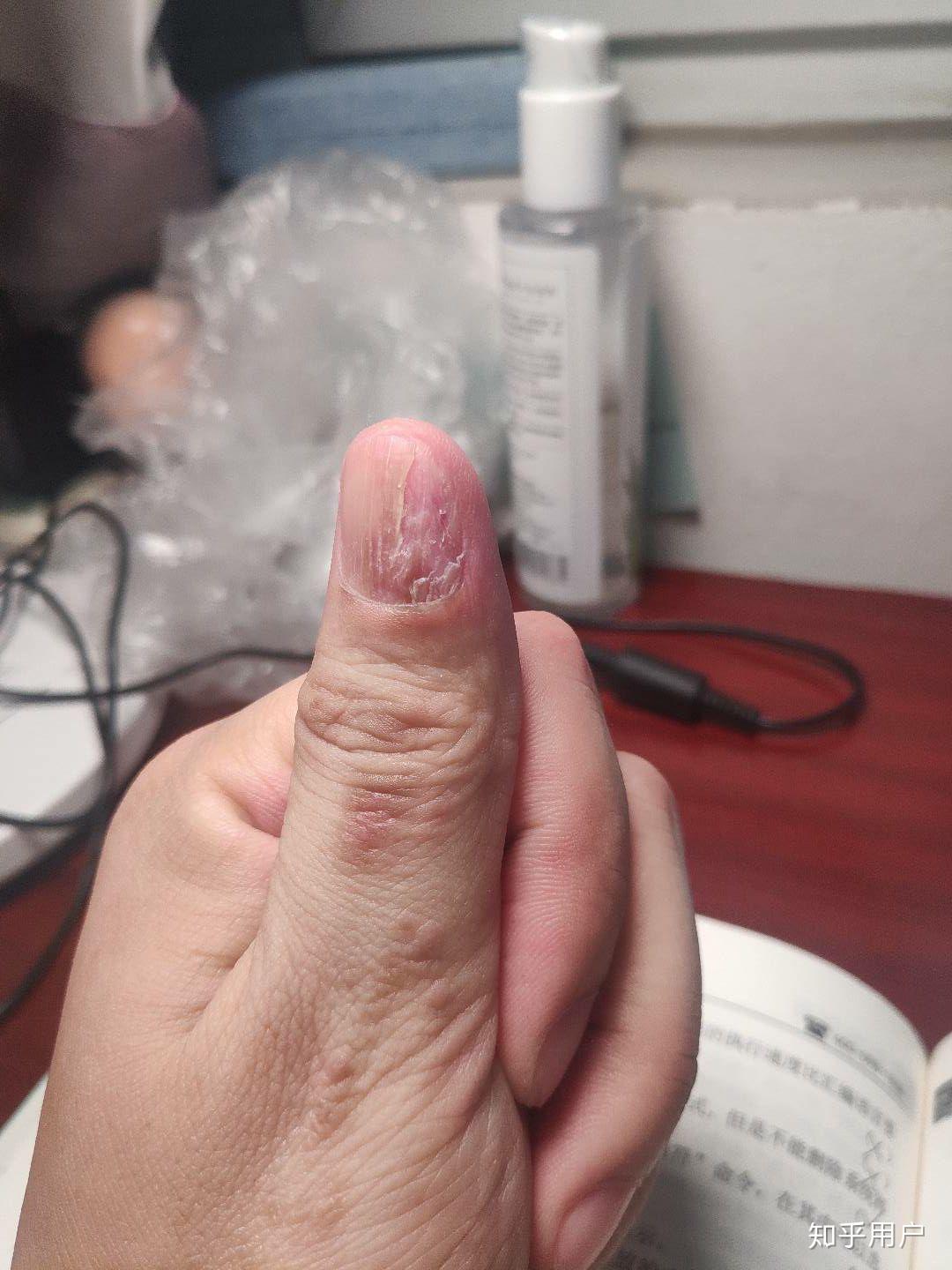 手指甲裂开了要怎么修复,治疗呢? - 知乎