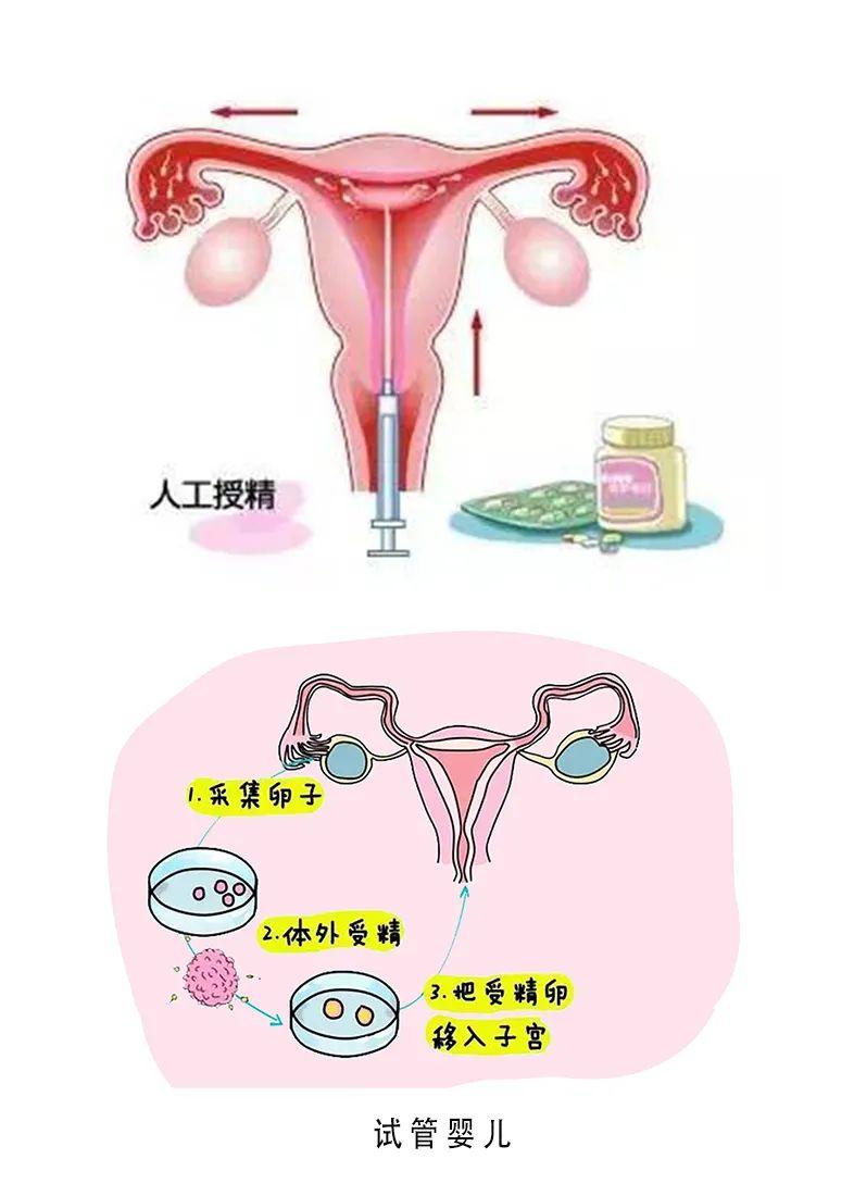 人工受孕和试管哪种好图片