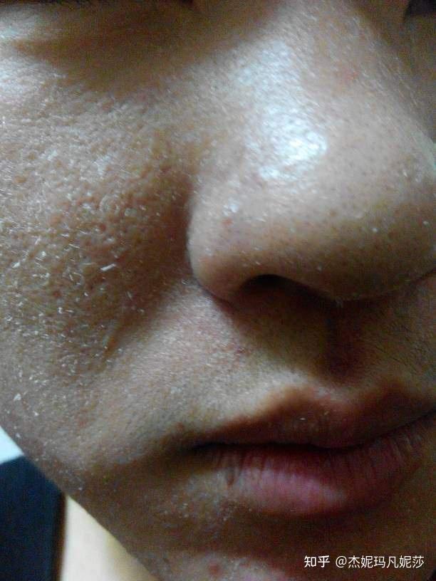 中性皮肤夏天空调房怎么补水