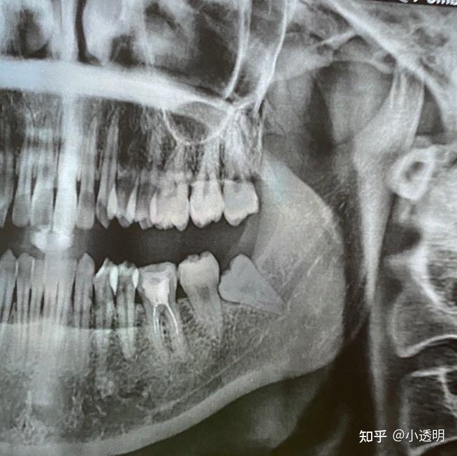 智齒長歪了怎麼辦在考慮拔牙但是不知道傷到神經了怎麼辦