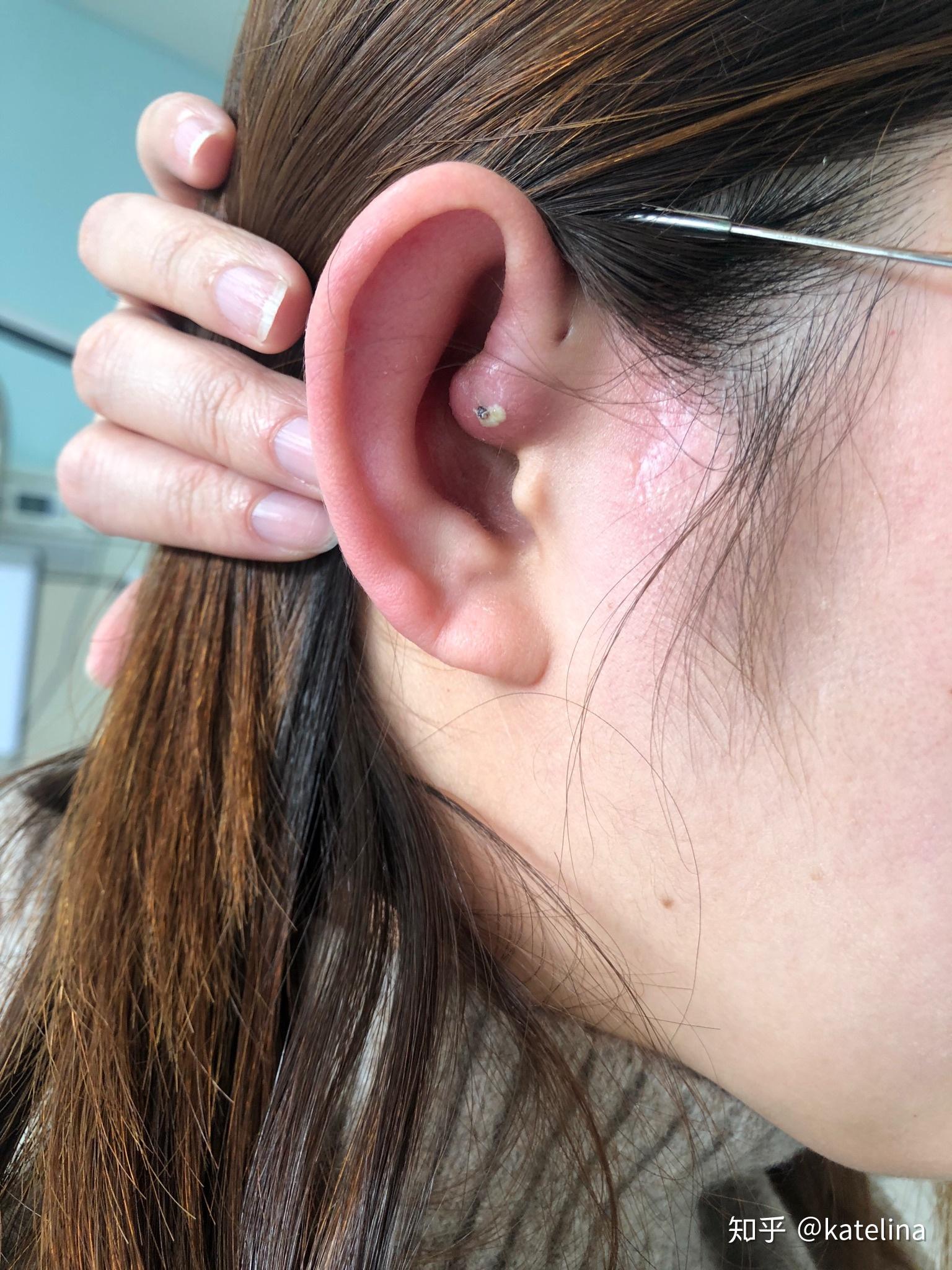 患有先天性耳前瘘管是一种怎样的体验? - 知乎