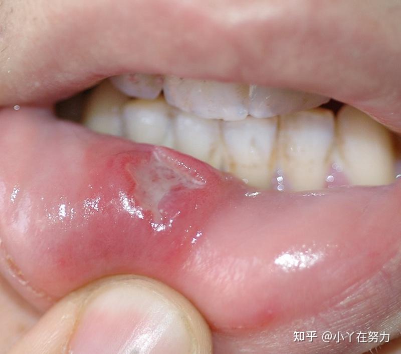 请问这是口腔硬下疳吗? 还是刚长好的口腔溃疡啊?