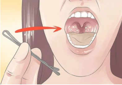 身体密码为何从喉咙里咳出一个剧臭的黄色颗粒